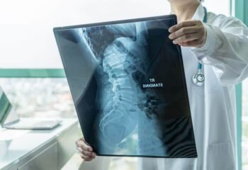 doctor looking at a spinal xray of a patient injured in an accident